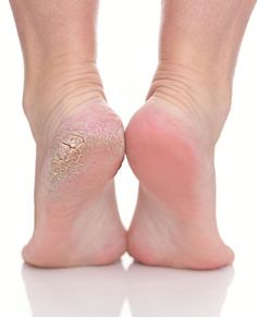 🌟 Begrüßen Sie weiche, glatte Füße in nur 10 Minuten! 👣